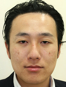 熊倉さん、セオリークリニックの目の下のたるみ治療体験レポート画像4